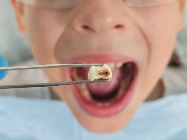 Best Emergency Dental Care for Broken or Chipped Teeth in Ozona, TX